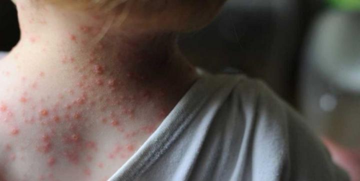 Del Covid a la Viruela del mono: El mapa de las enfermedades cambia con los nuevos hábitos